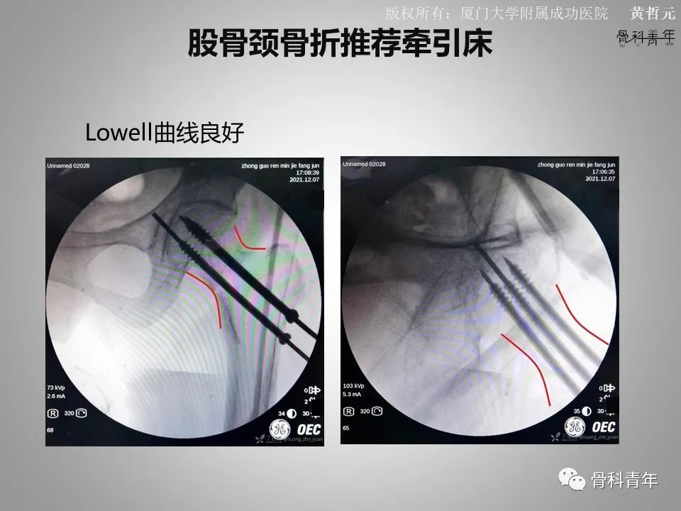一文掌握股骨颈骨折的分型、复位与内固定！