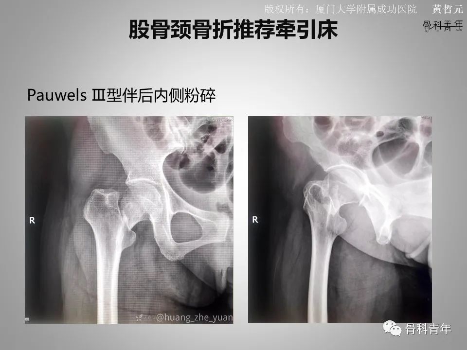 一文掌握股骨颈骨折的分型、复位与内固定！