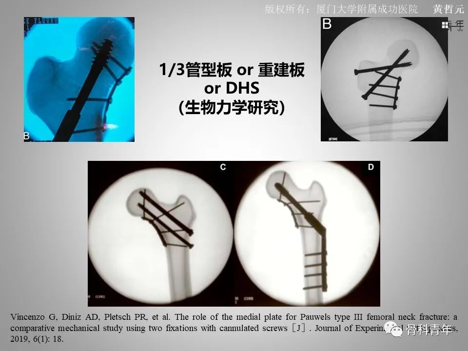 一文掌握股骨颈骨折的分型、复位与内固定！