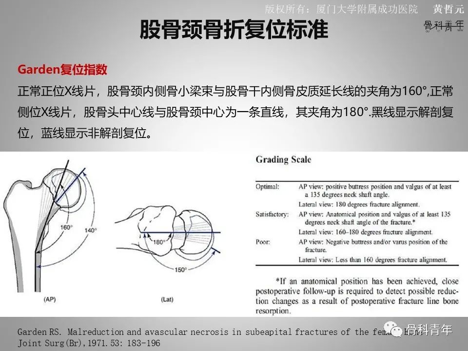 一文掌握股骨颈骨折的分型、复位与内固定！