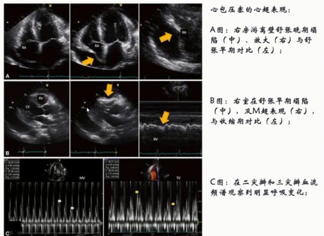 关于心包积液需要掌握的干货知识点