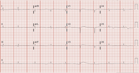 心电图挑战：低而慢的QRS，幕后真凶是谁？