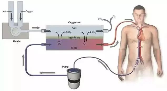 体外肺膜氧合系统(ECMO)最全攻略