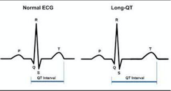 预示猝死的心电图异常：QT间期延长
