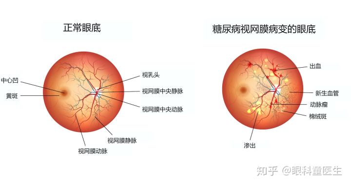 认识糖尿病视网膜病变