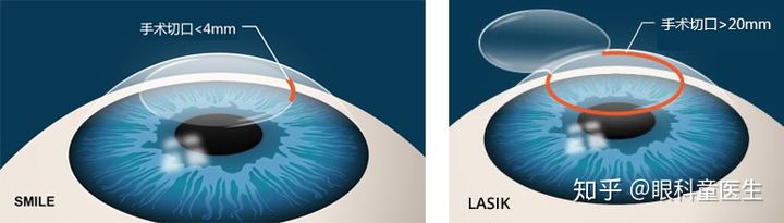 激光近视矫正手术：你想知道的