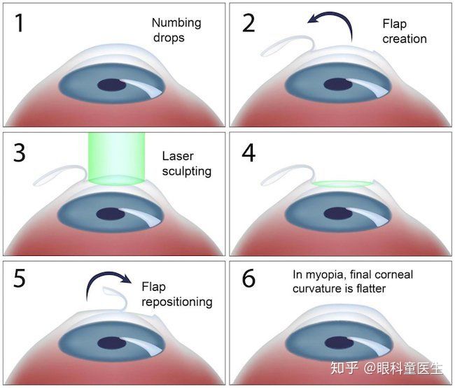 激光近视矫正手术：你想知道的