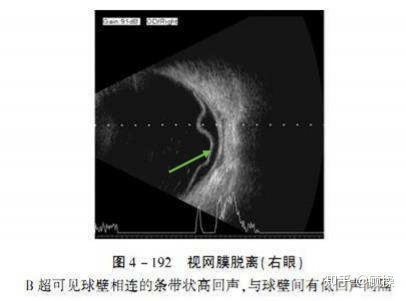 孔源性视网膜脱离该如何诊断？