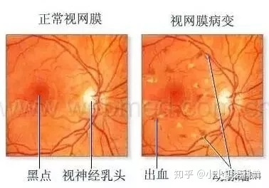 糖尿病眼病患者眼底有哪些变化