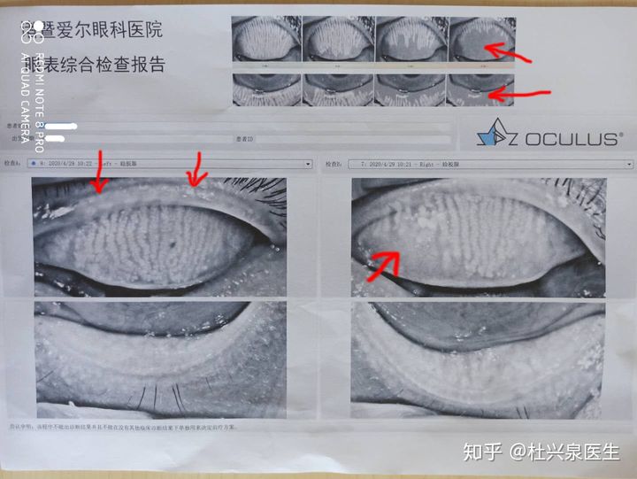 干眼症诊断与治疗之我见--干眼症详解