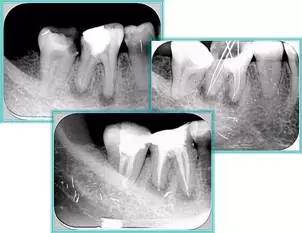 牙齿“晓”“技”|最全根管治疗的标准步骤，以及细节把握