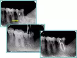 牙齿“晓”“技”|最全根管治疗的标准步骤，以及细节把握