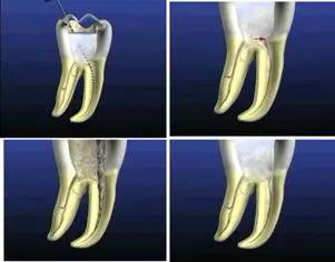 牙齿“晓”“技”|最全根管治疗的标准步骤，以及细节把握