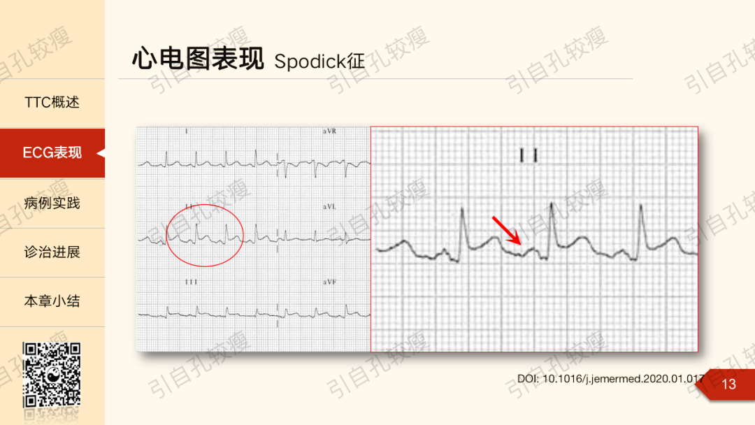急性心包炎心电图表现有哪些？