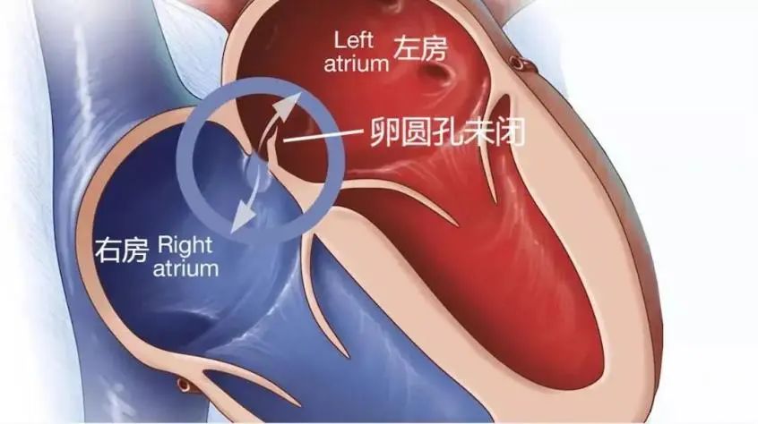 卵圆孔未闭和小房缺是咋回事？