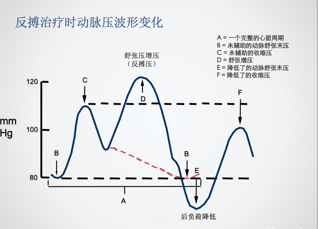 主动脉内球囊反搏操作规范