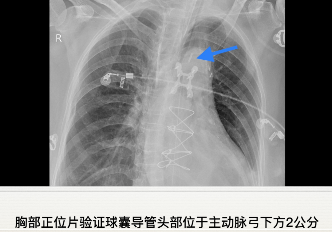 主动脉内球囊反搏操作规范