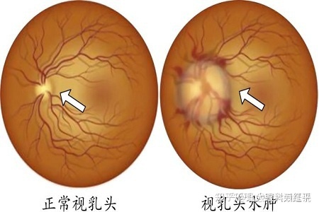 视乳头水肿有哪些临床表现