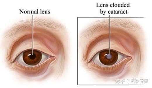 关于白内障的9个有争议的问题，你真的了解吗？