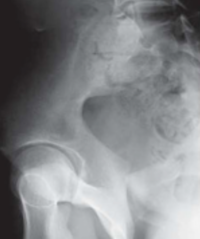 被称为“致命骨折”的骨盆骨折，如何快速准确诊断与评估？