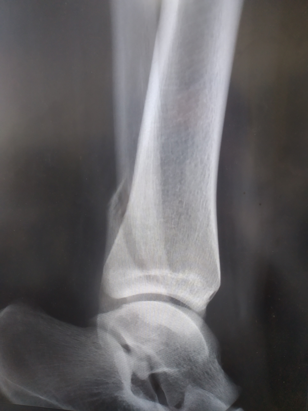 一文搞懂踝关节骨折中的Lauge-Hansen分型与Weber分型