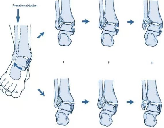 一文搞懂踝关节骨折中的Lauge-Hansen分型与Weber分型