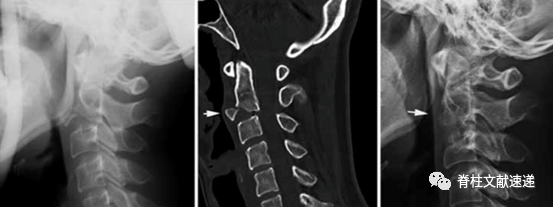 上颈椎骨折的常用分型有哪些？