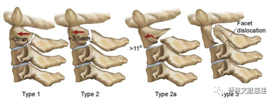 上颈椎骨折的常用分型有哪些？