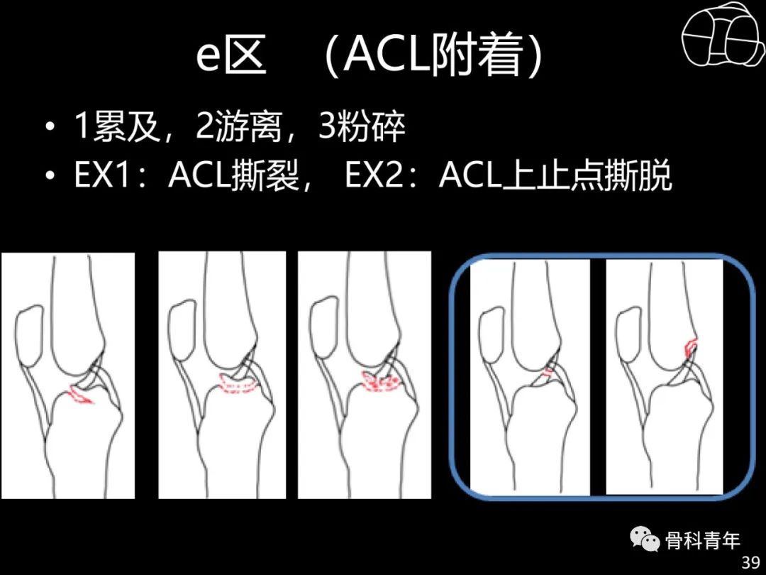 胫骨平台骨折“四柱九区分型”理论介绍