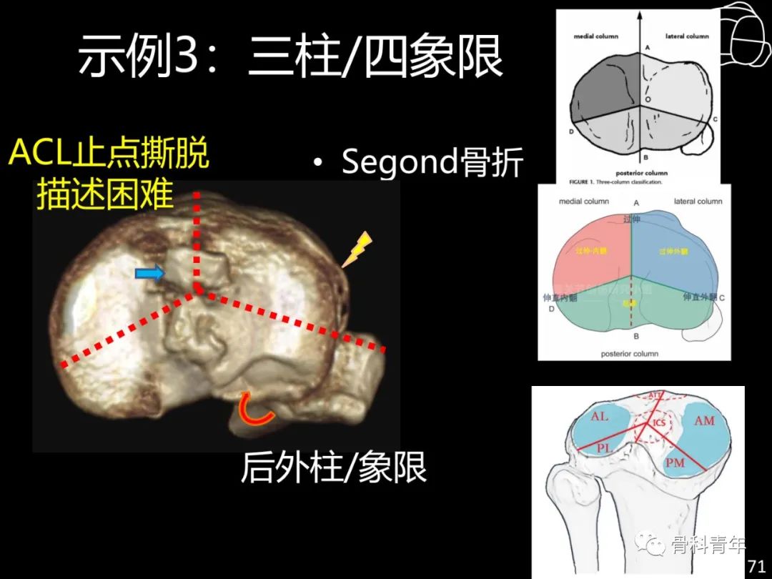 胫骨平台骨折“四柱九区分型”理论介绍