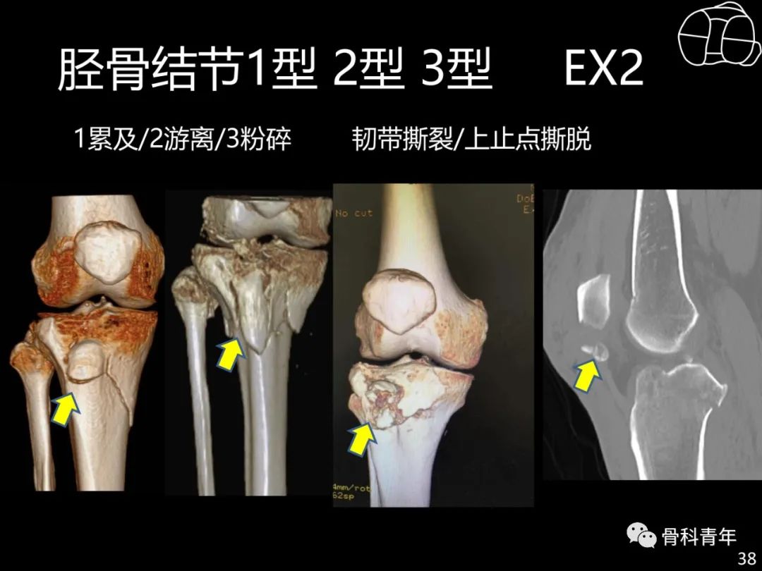 胫骨平台骨折“四柱九区分型”理论介绍