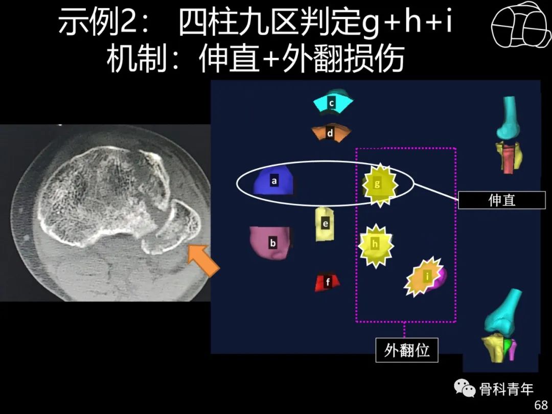 胫骨平台骨折“四柱九区分型”理论介绍