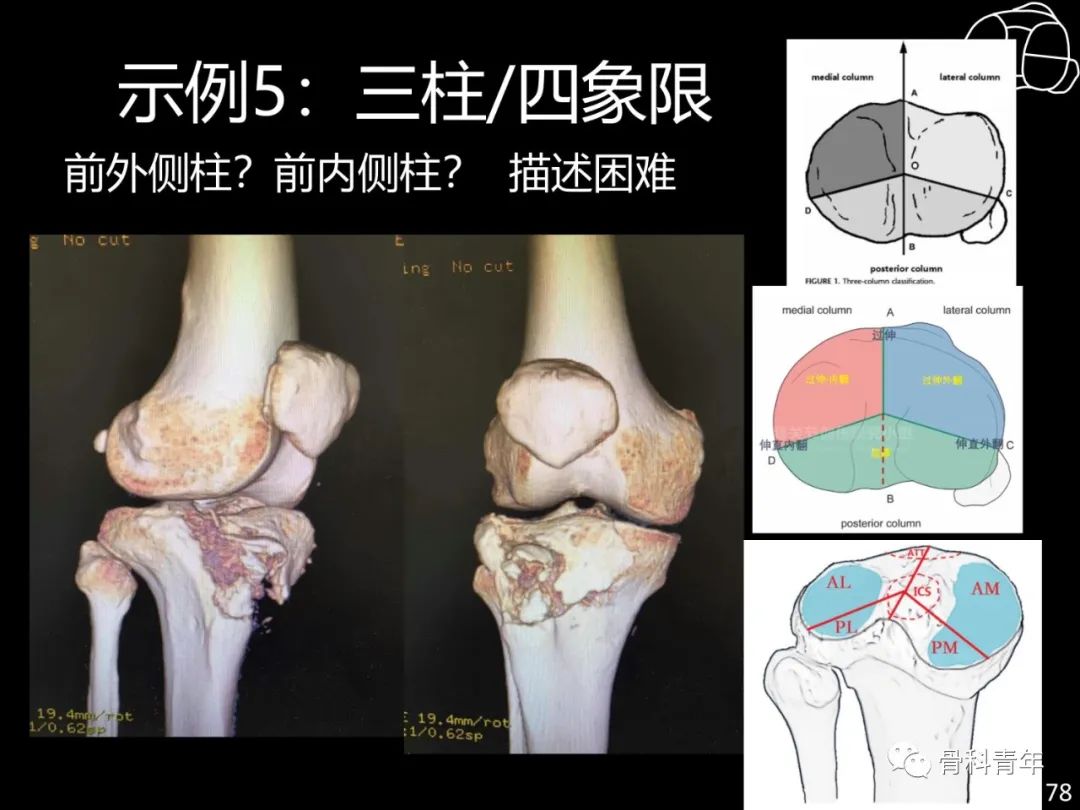 胫骨平台骨折“四柱九区分型”理论介绍