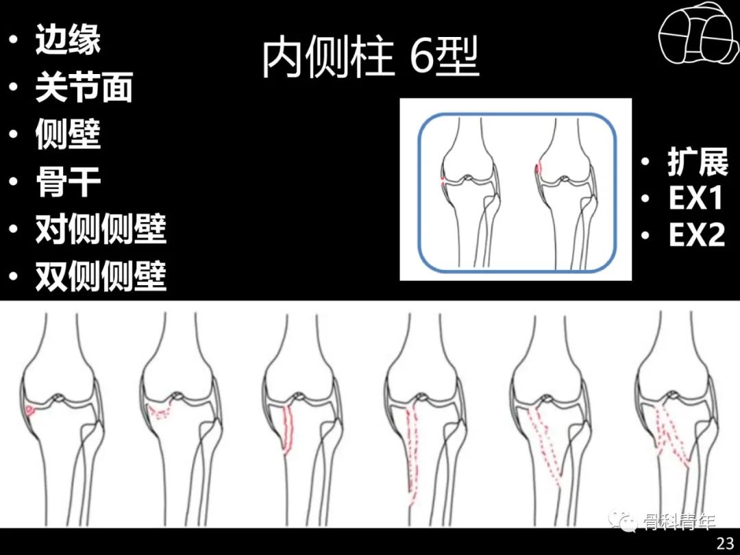 胫骨平台骨折“四柱九区分型”理论介绍