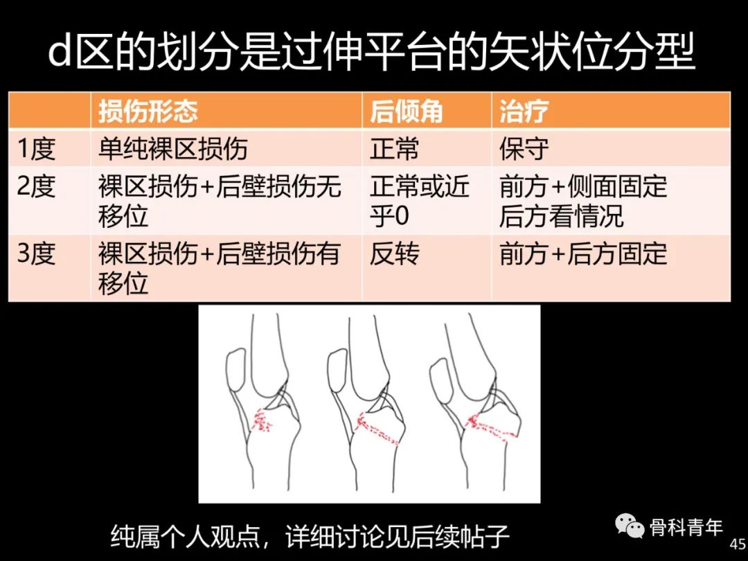 胫骨平台骨折“四柱九区分型”理论介绍