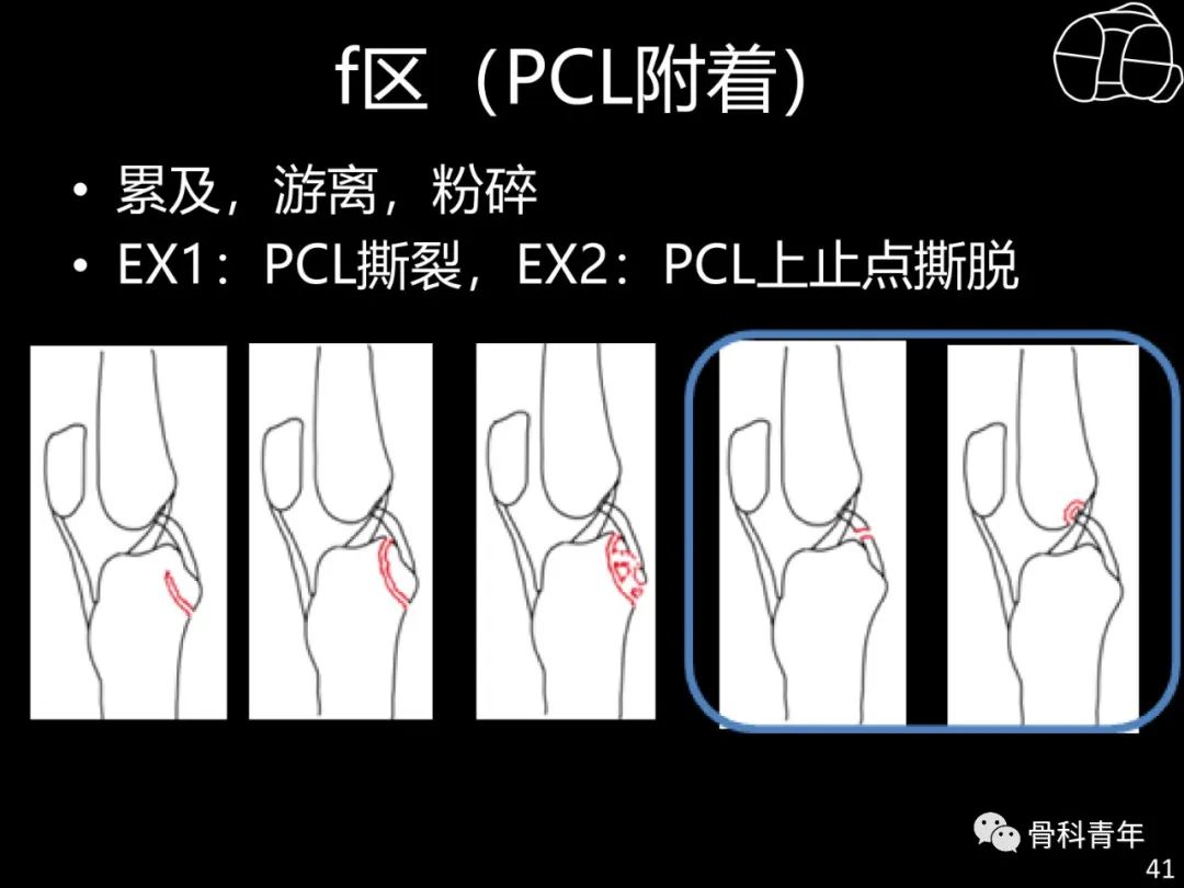 胫骨平台骨折“四柱九区分型”理论介绍