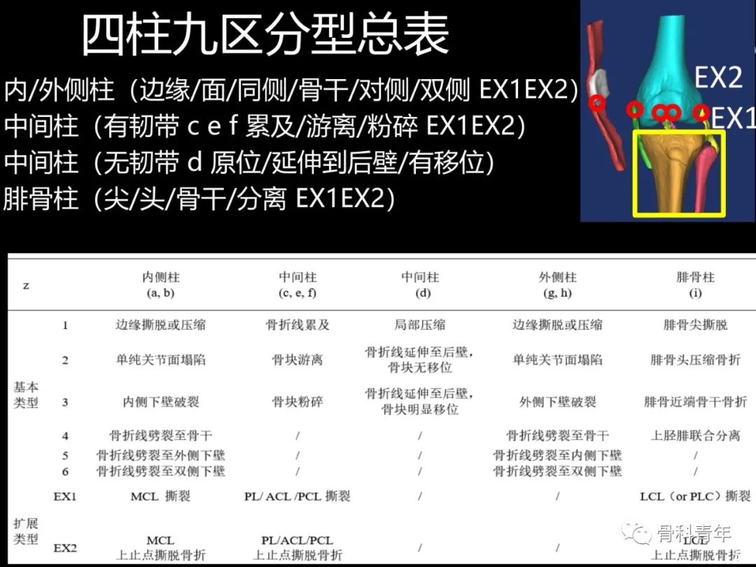 胫骨平台骨折“四柱九区分型”理论介绍