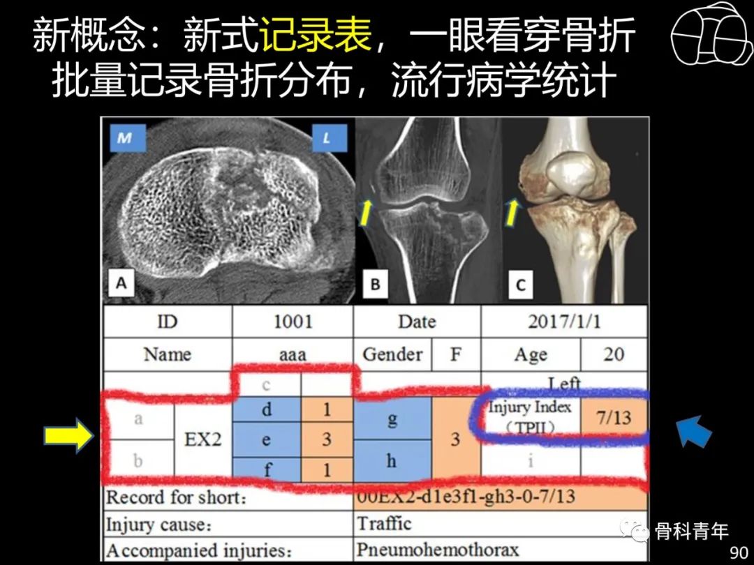 胫骨平台骨折“四柱九区分型”理论介绍