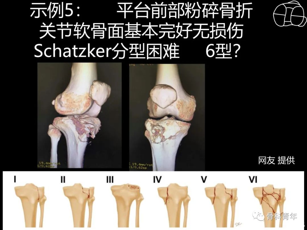 胫骨平台骨折“四柱九区分型”理论介绍