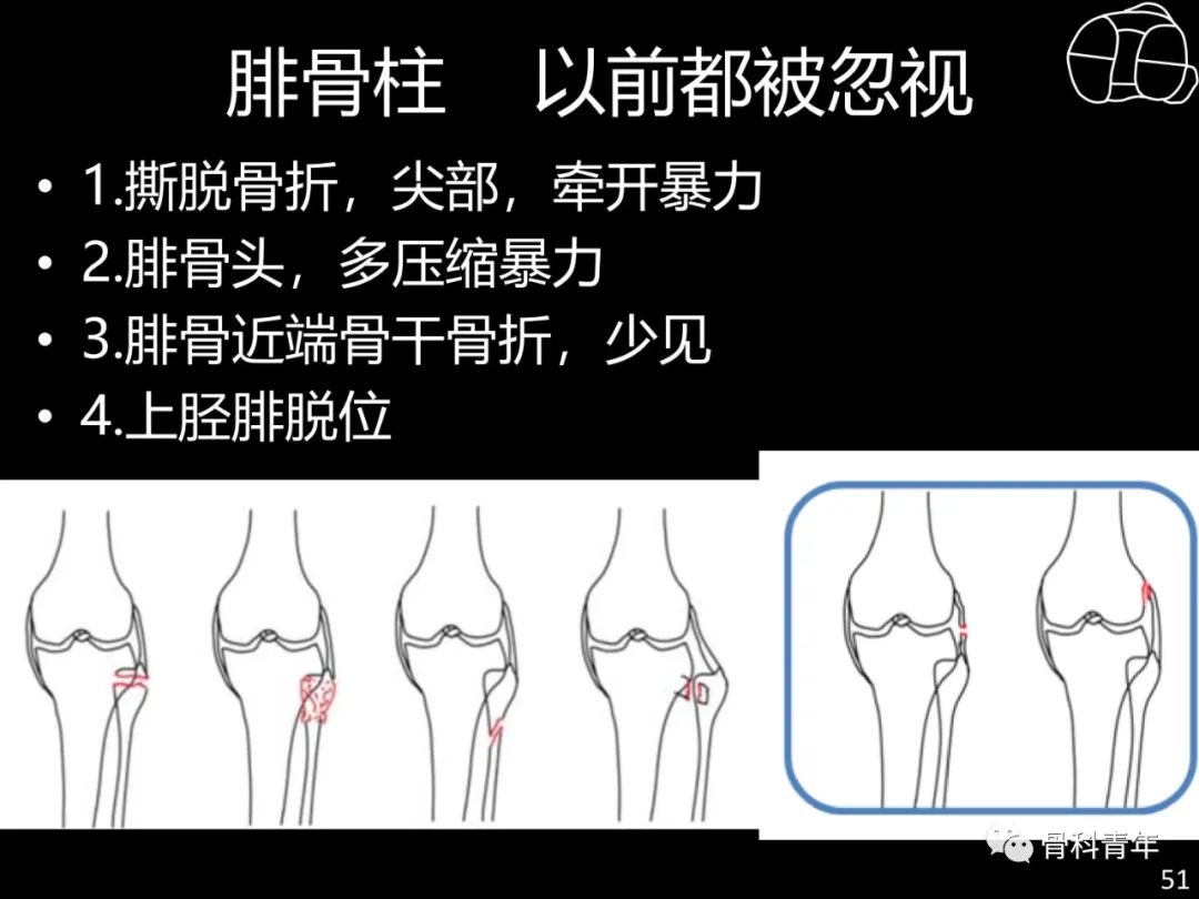 胫骨平台骨折“四柱九区分型”理论介绍