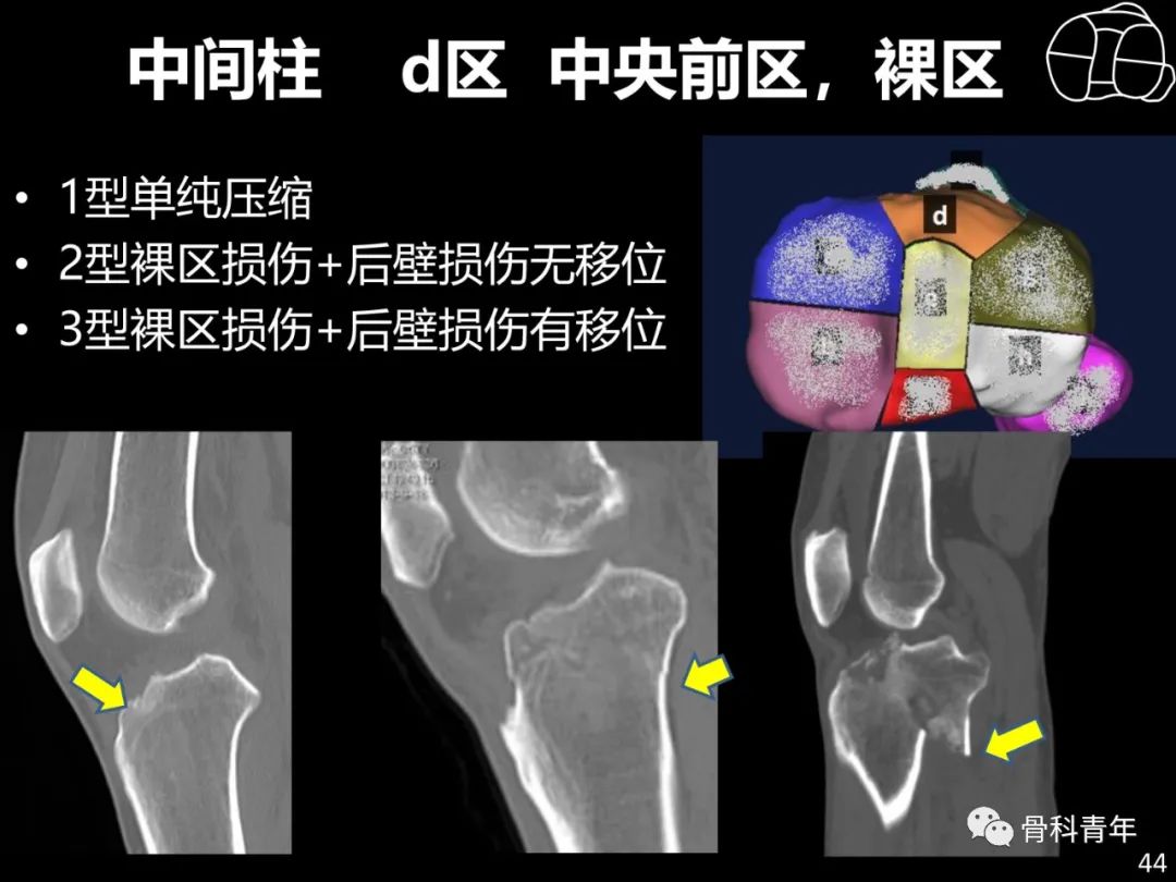 胫骨平台骨折“四柱九区分型”理论介绍