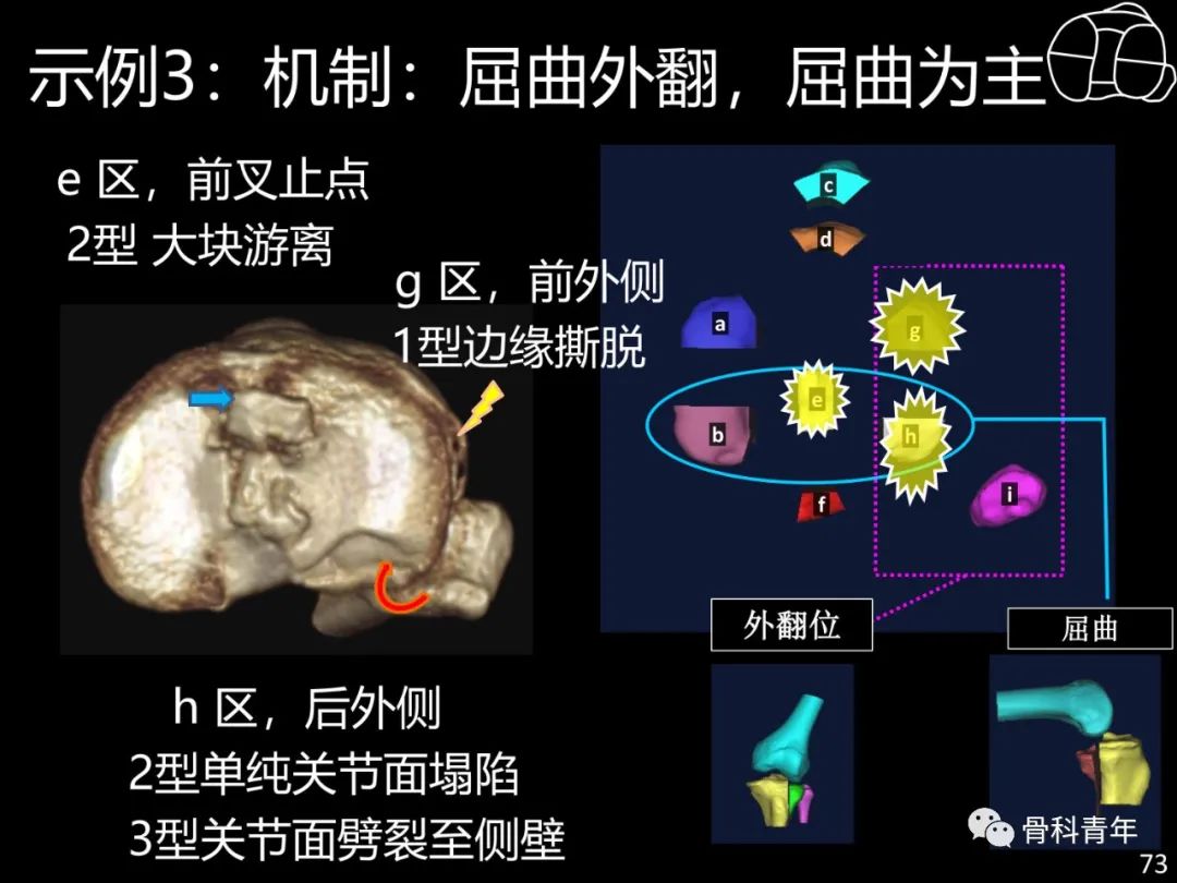 胫骨平台骨折“四柱九区分型”理论介绍