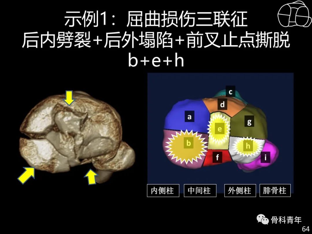 胫骨平台骨折“四柱九区分型”理论介绍