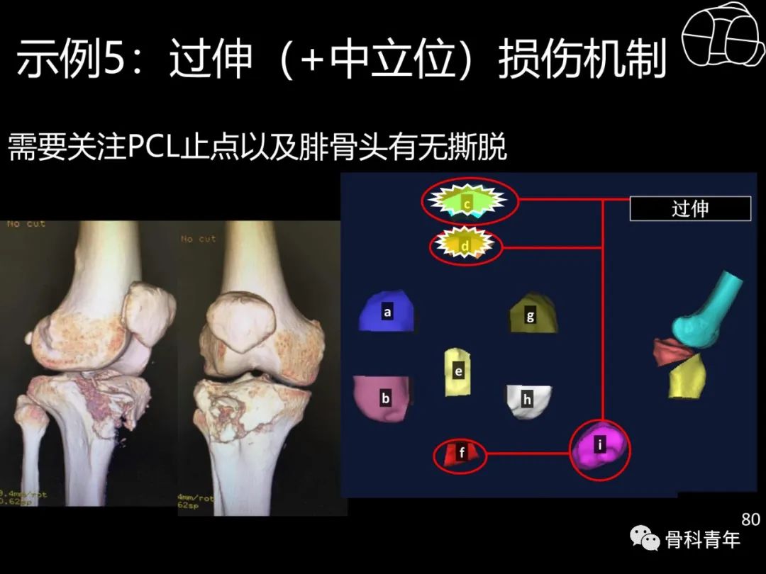 胫骨平台骨折“四柱九区分型”理论介绍