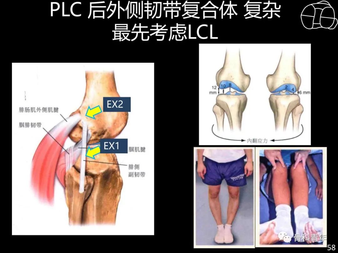 胫骨平台骨折“四柱九区分型”理论介绍