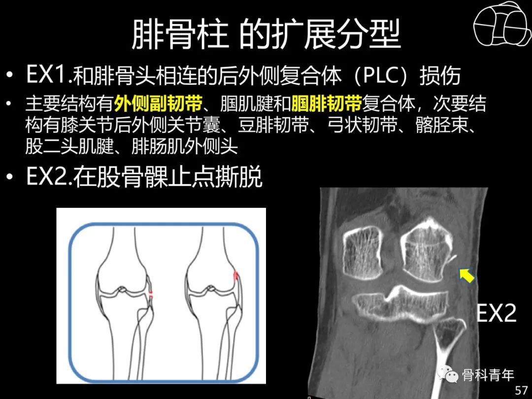 胫骨平台骨折“四柱九区分型”理论介绍