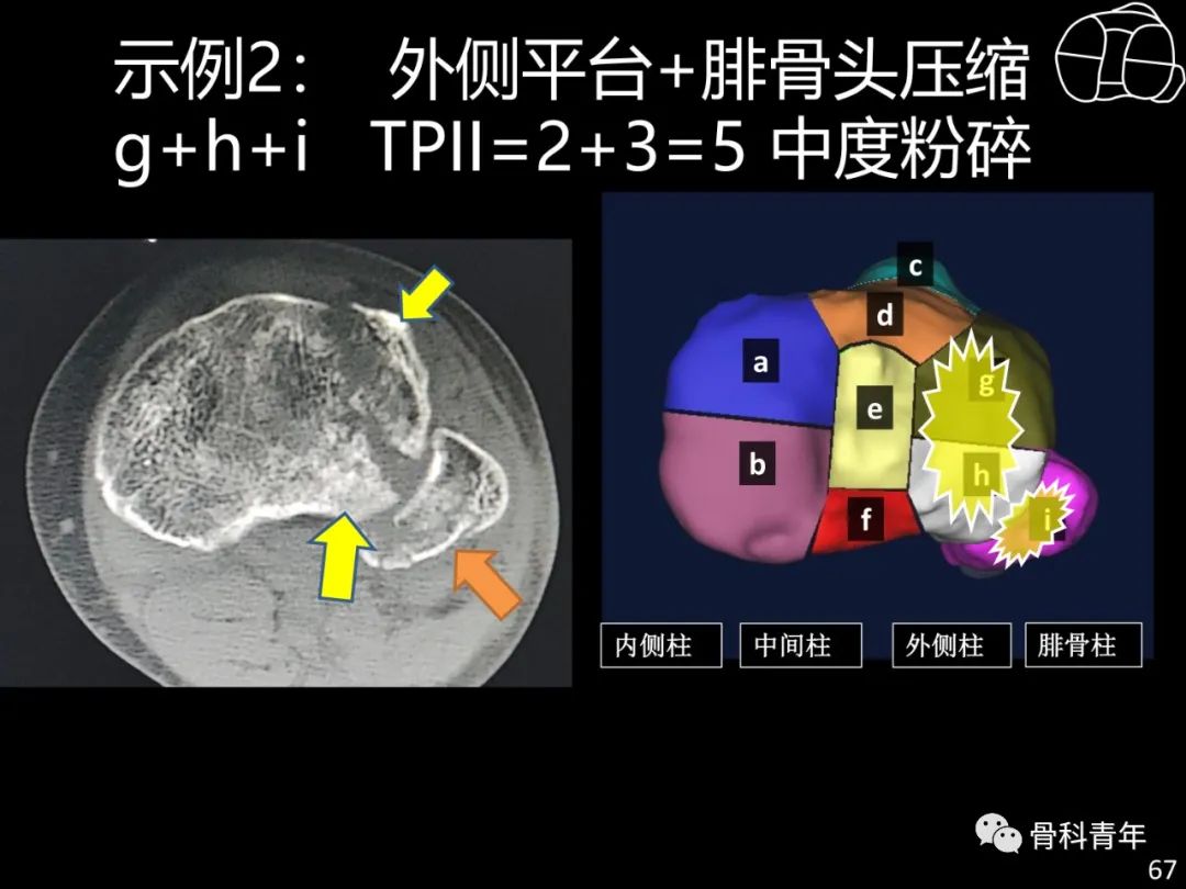 胫骨平台骨折“四柱九区分型”理论介绍