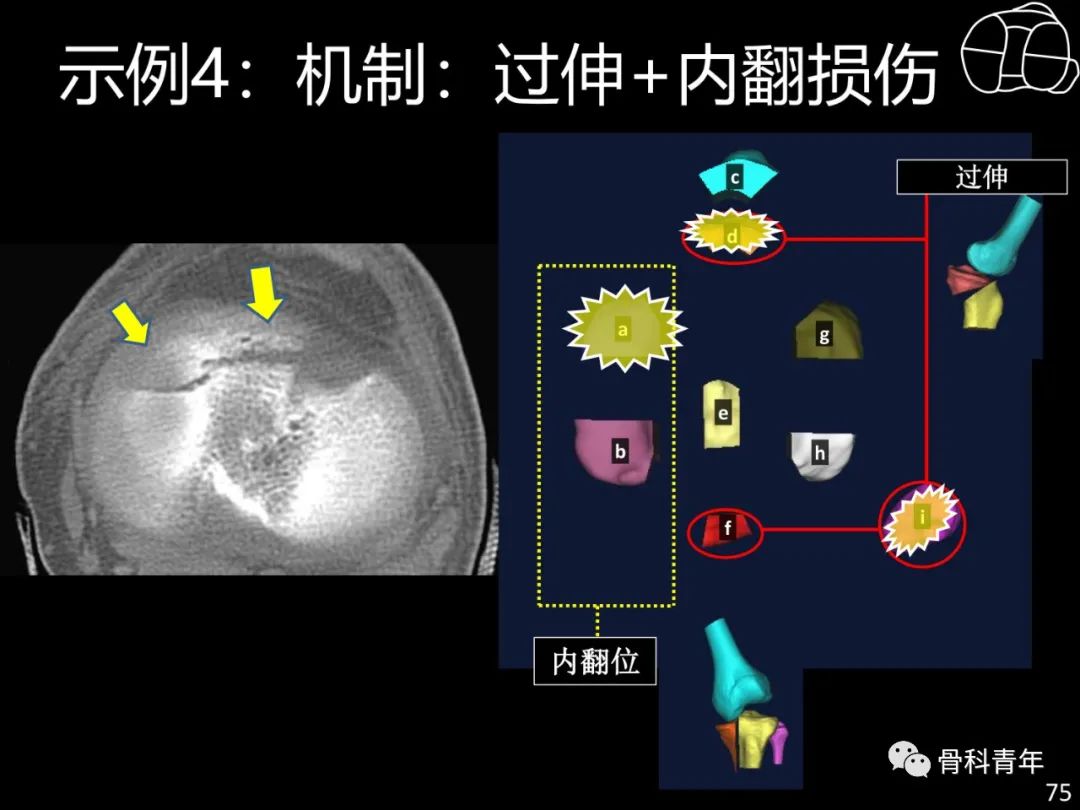 胫骨平台骨折“四柱九区分型”理论介绍