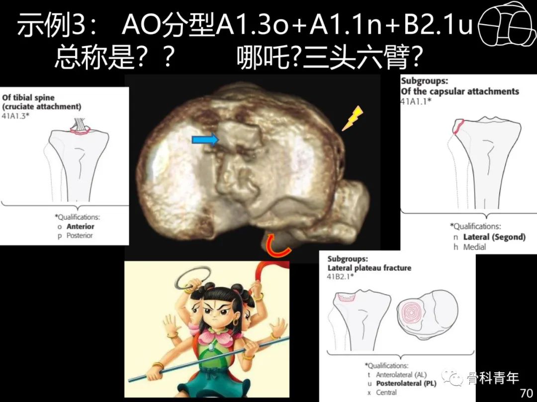 胫骨平台骨折“四柱九区分型”理论介绍