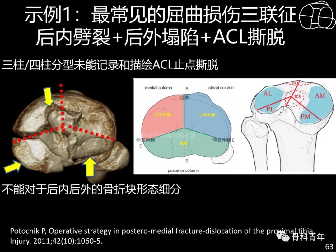 胫骨平台骨折“四柱九区分型”理论介绍